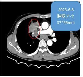 永兴县人民医院：肺癌靶向治疗效果显著，患癌不再是噩梦