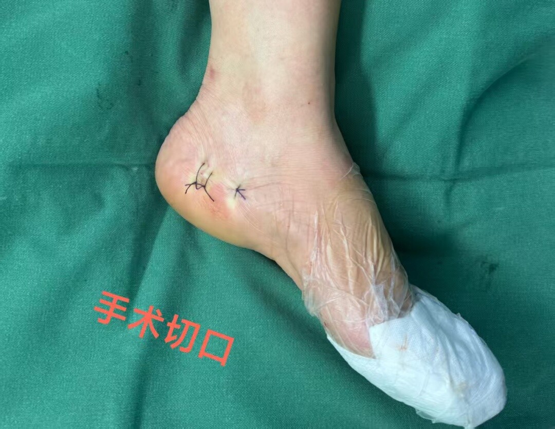 永兴县人民医院：成功完成跟骨骨刺微创切除术  足跟痛治疗进入“超微创”时代