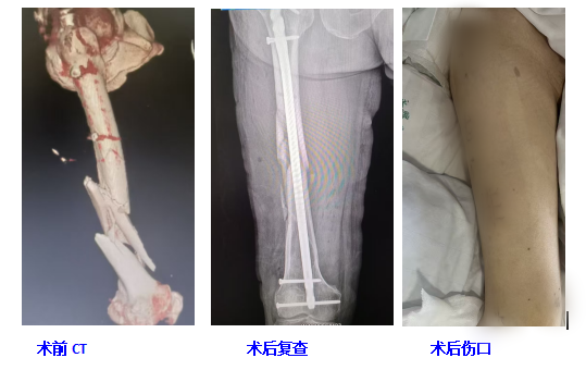 精修微创复位，稳固断骨支撑——永兴县人民医院顺利完成复杂股骨干粉碎性骨折髓内钉内固定术